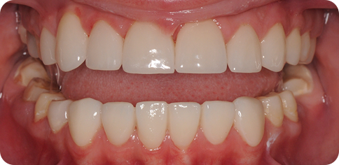 Dental Caries Prone Teeth after treatment at TruSmile Muscat