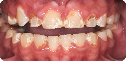 Dental Caries Prone Teeth before treatment at TruSmile Muscat