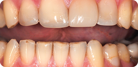 Dental Replacing Old Crown after treatment at TruSmile Muscat