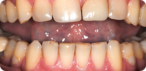 Dental Replacing Old Crown before treatment at TruSmile Muscat