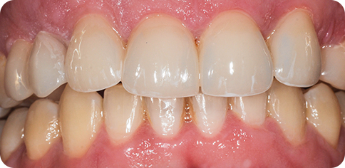 Dental Reshaping with Veneers after treatment at TruSmile Muscat