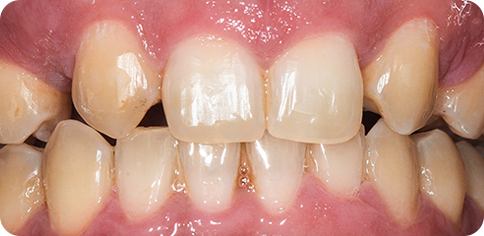 Dental Reshaping with Veneers before treatment at TruSmile Muscat