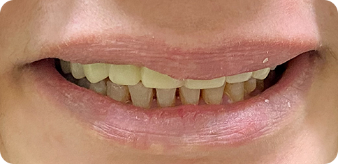 Dental simile enhancement after treatment at TruSmile Muscat
