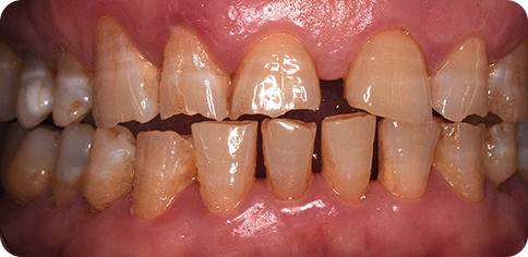 Oman Smile Enhancement before treatment at TruSmile Muscat