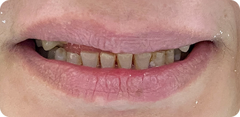 Dental simile enhancement before treatment at TruSmile Muscat