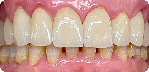 Oman Smile Enhancement after treatment at TruSmile Muscat