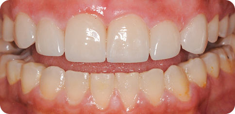 Dental Smile Make Over after treatment at TruSmile Muscat