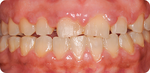 Dental Smile Make Over before treatment at TruSmile Muscat