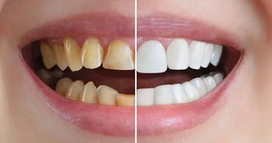 Cosmetic and aesthetic dentistry services in Muscat Oman including veneers, teeth whitening and smile makeover