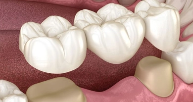 Dental implants and tooth replacement solutions in Muscat Oman