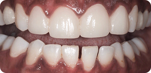 Dental veneers after treatment at TruSmile Muscat