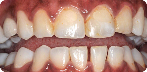 Dental veneers before treatment at TruSmile Muscat
